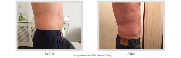 Aqualyx Fat Dissolving Cosmetic Results become Visible